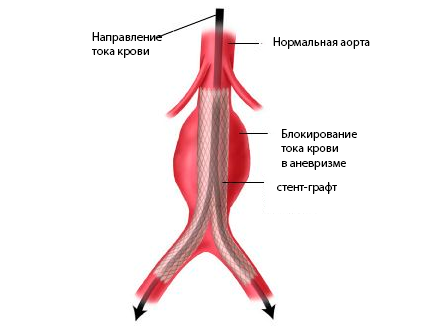 стент-графт в аневризме брюшной аорты стент-графт в аневризме брюшной аорты